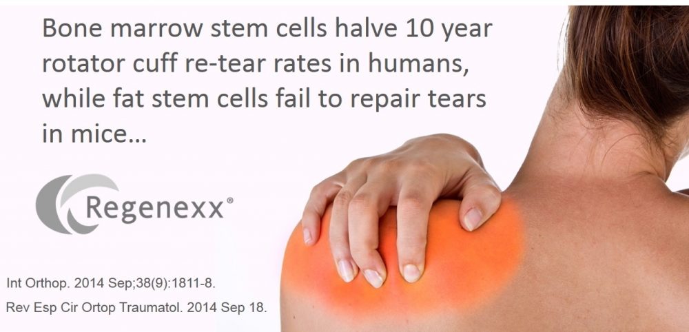Fat Stem Cells Fail to Help Shoulder Rotator Cuff Injuries Heal