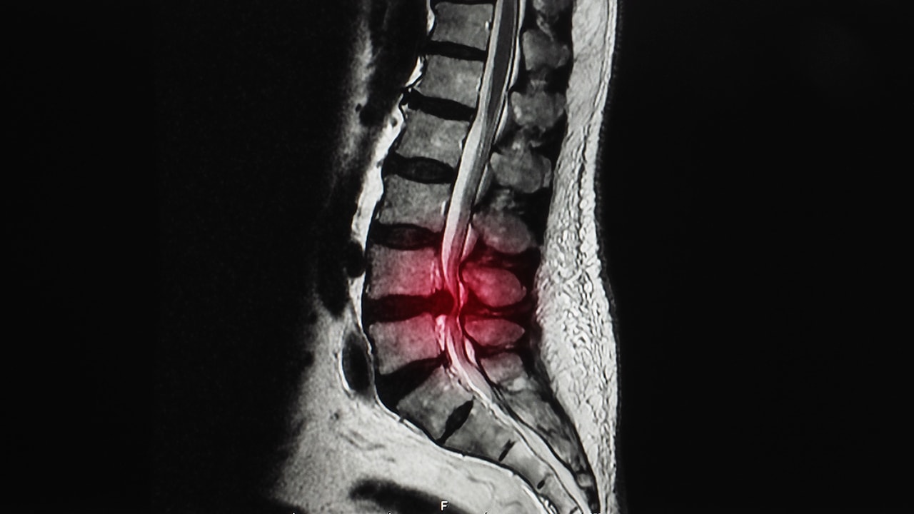 new-research-an-mri-with-stenosis-doesn-t-diagnose-your-pain