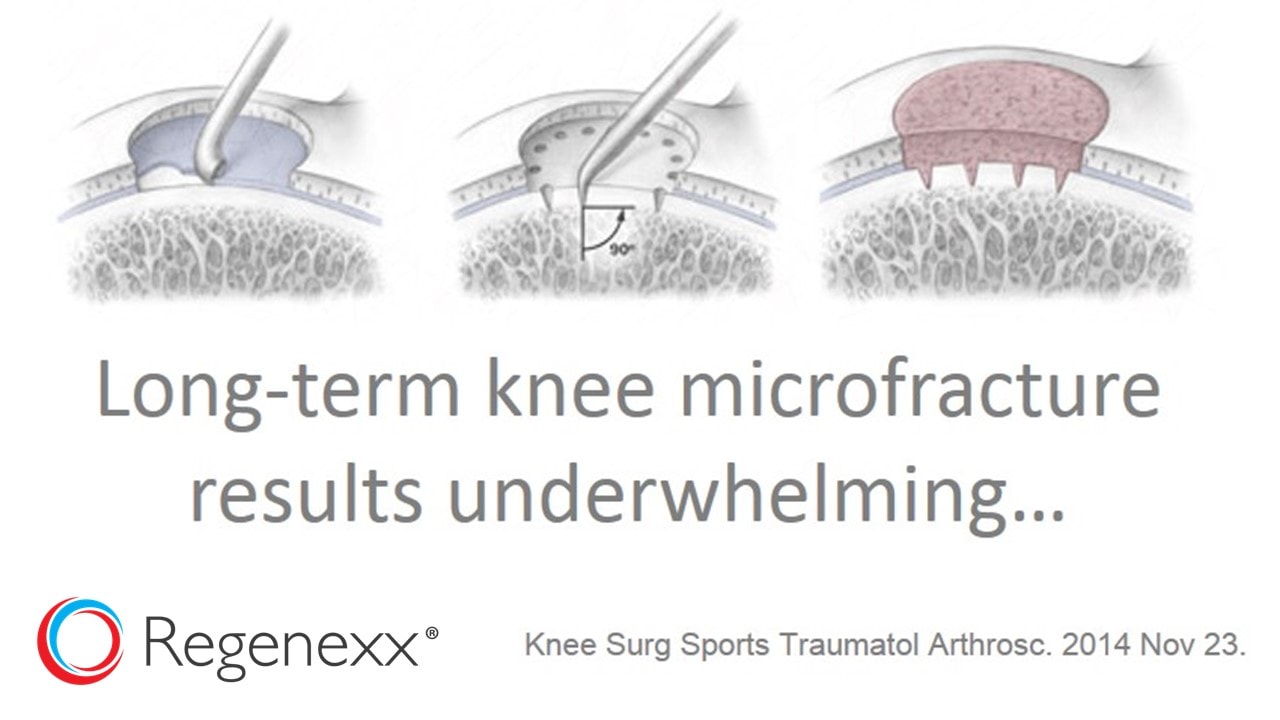 knee-microfracture-results