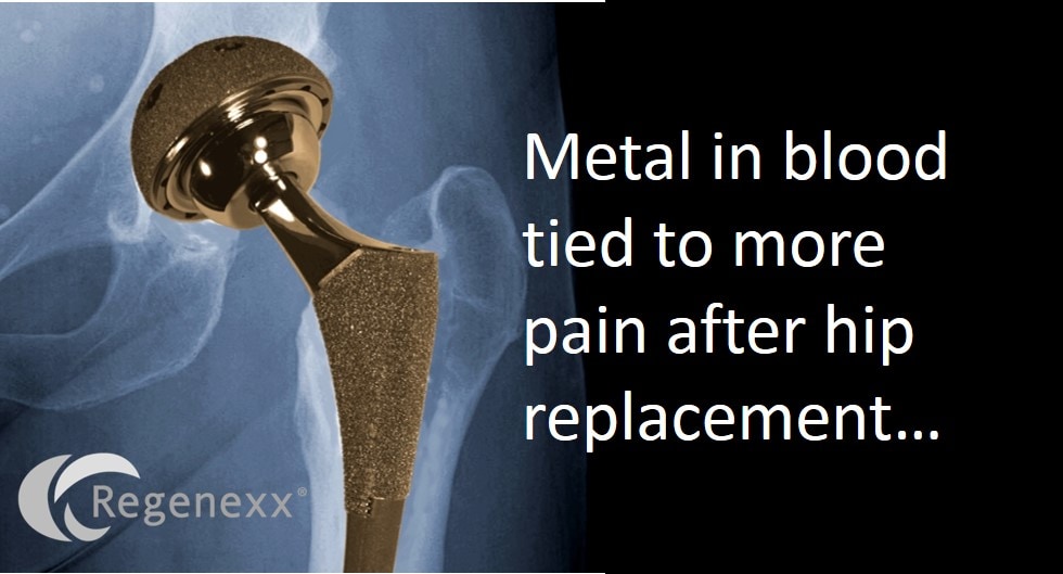 Why You Should Seek Hip Replacement Alternatives: Metal in Your Blood…