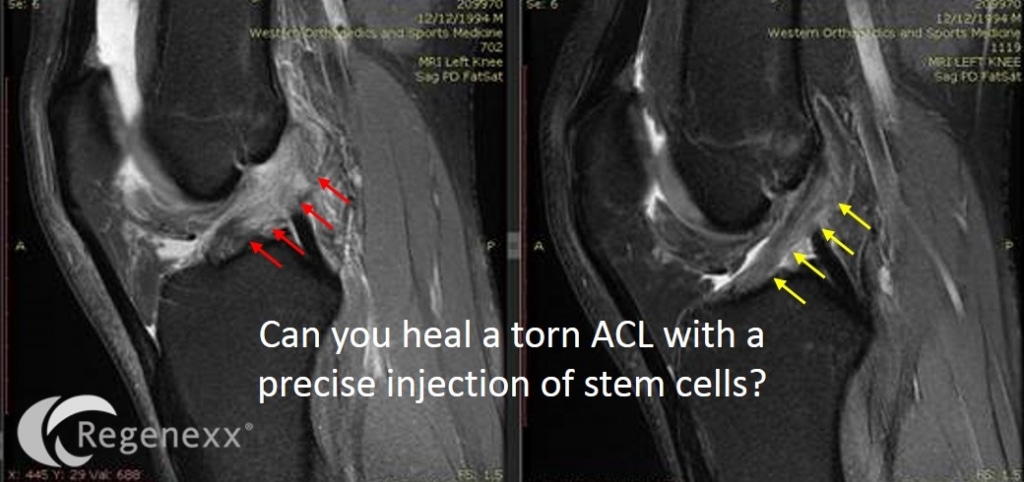 avoid knee acl surgery