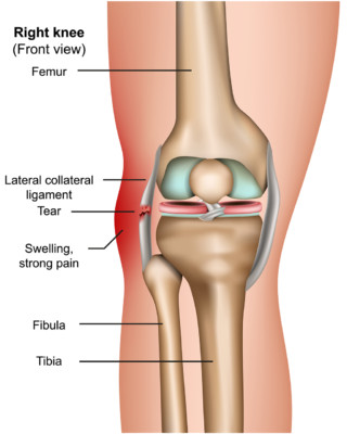 Medical illustration showing a knee affected by an MCL tear