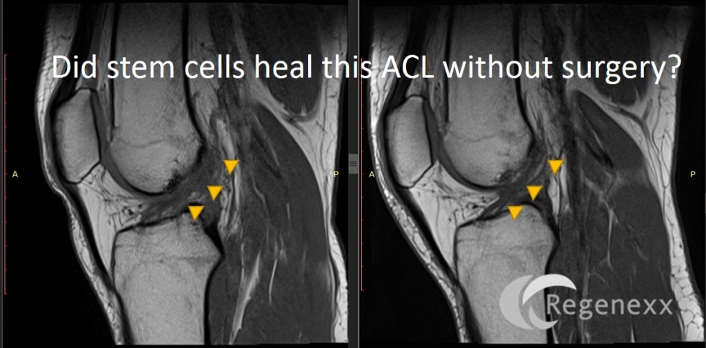 ACL surgery cost