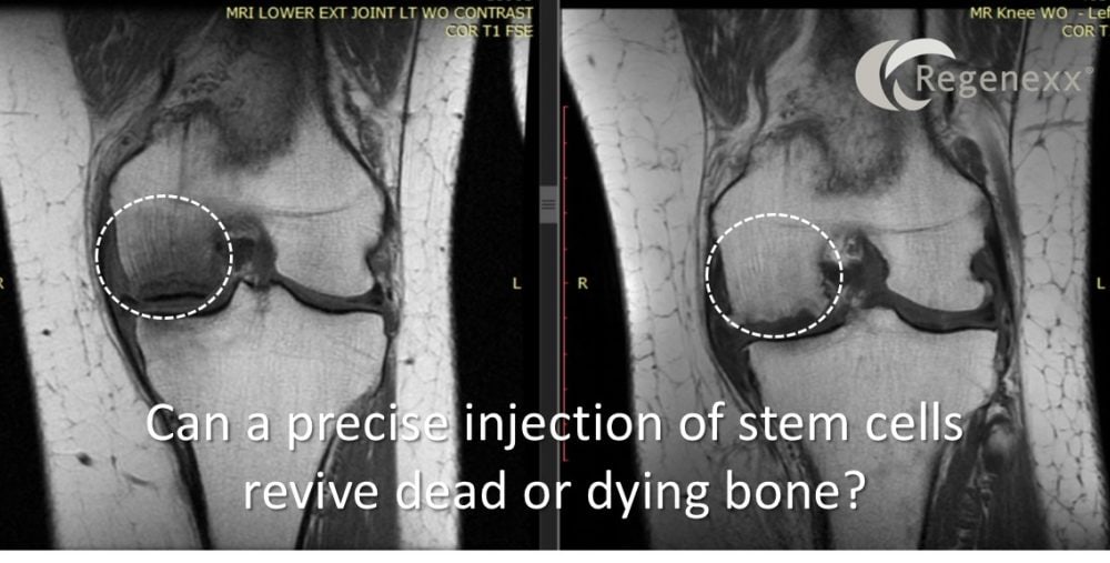 Knee Osteonecrosis Alternatives: Can a Precise Injection Rescue Dying Bone?