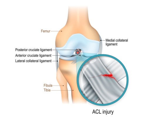 Medical illustration showing the anatomy of the knee with a torn anterior cruciate ligament