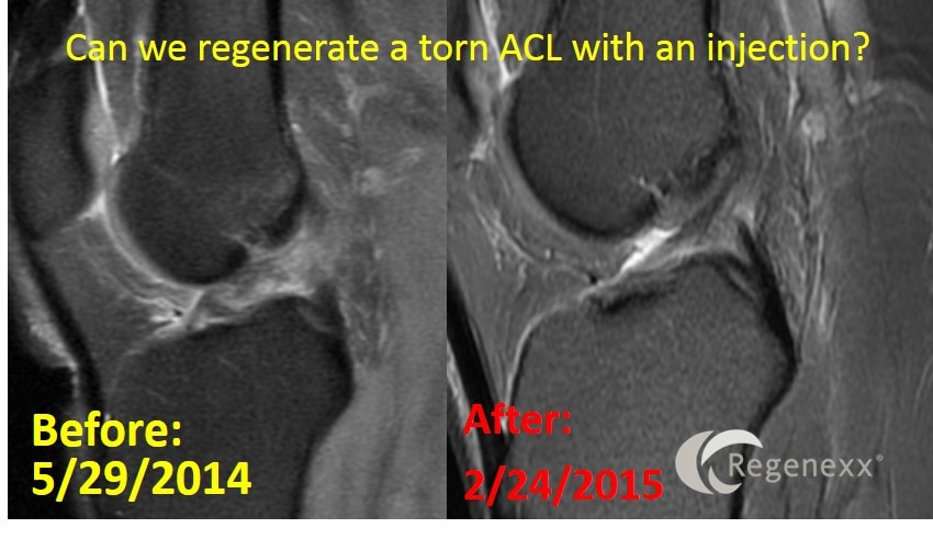 Why Deal with ACL Surgery Complications?