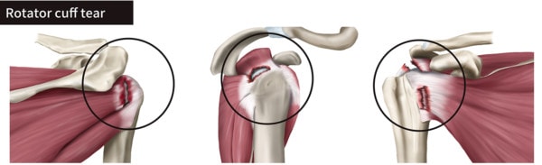 Medical illustration showing three tears of the rotator cuff