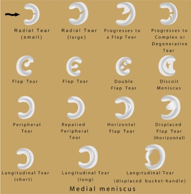 Medical infographic showing sixteen types of meniscus tears