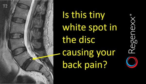 MRI of the spine with a yellow arrow pointing to a disc with the text: is this tiny white spot in the disc causing your back pain?