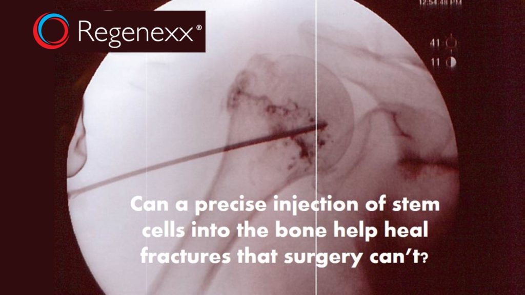 stem cell fracture healing help