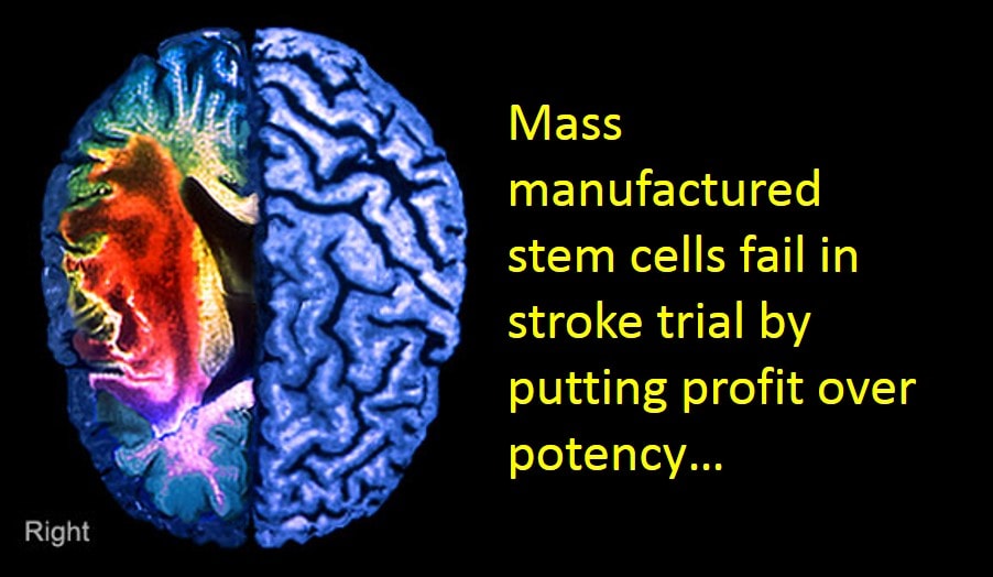 Mass Manufactured Stem Cells Fail in Stroke Trial
