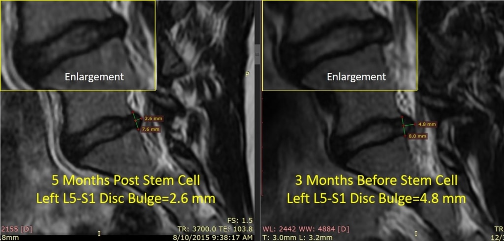 low back disc stem cell