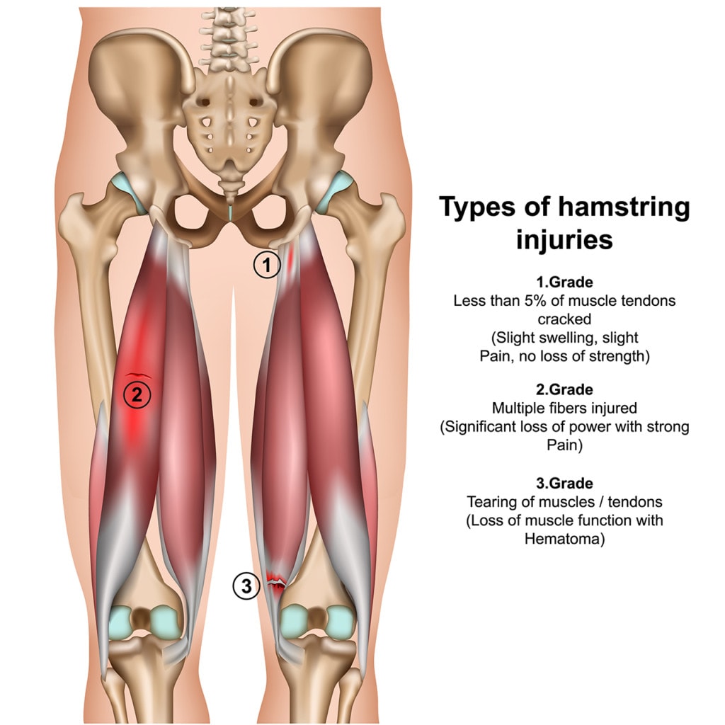 when-is-hamstring-surgery-necessary-meet-abby-regenexx-blog