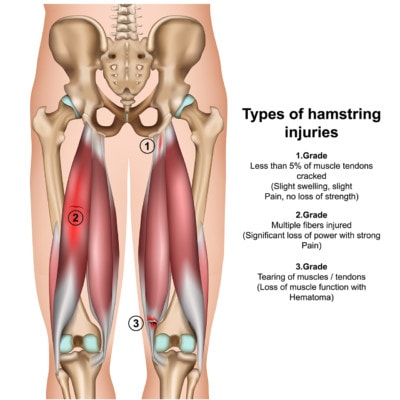 Medical illustration showing the hamstrings and three types of common injuries 