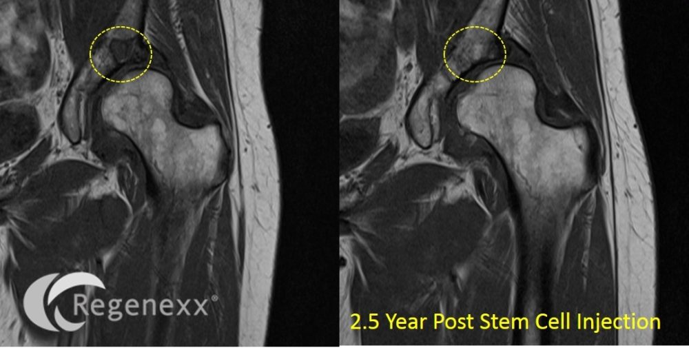 Hip Arthritis Stem Cell Injection: 2.5 Years Later…