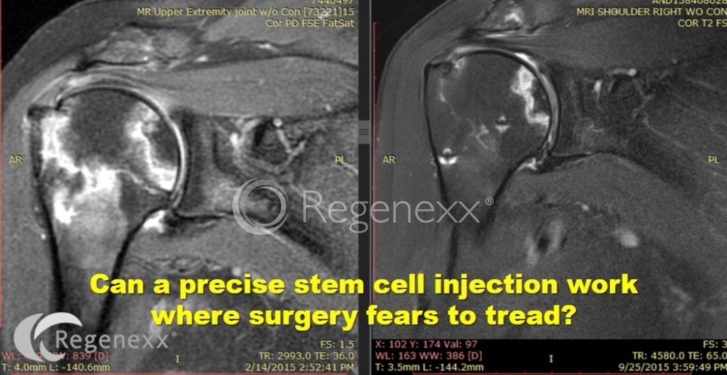 shoulder stem cell injection avn
