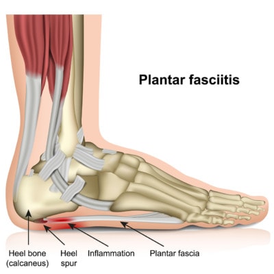 Medical illustratio showing the anatomy of a foot affected by plantar fasciitis