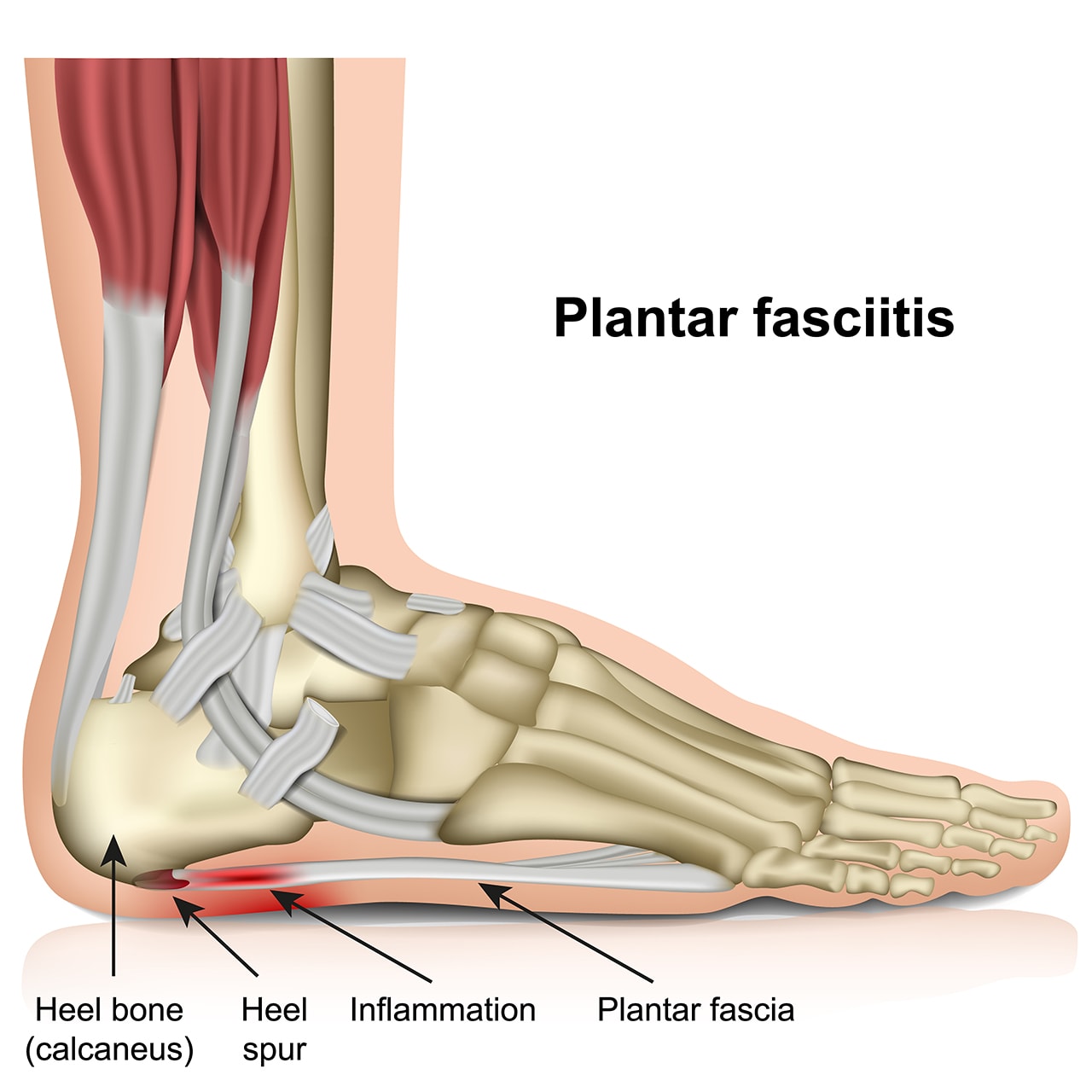 WILLED Heel Protectors, Heel Cups for Plantar Fasciitis, Adjustable  Breathable Heel Pads, Support Insoles for Tendinitis Heel Spur Aching Feet  Relieve (Size: Women 6-11 / Men 6-10) - Walmart.com