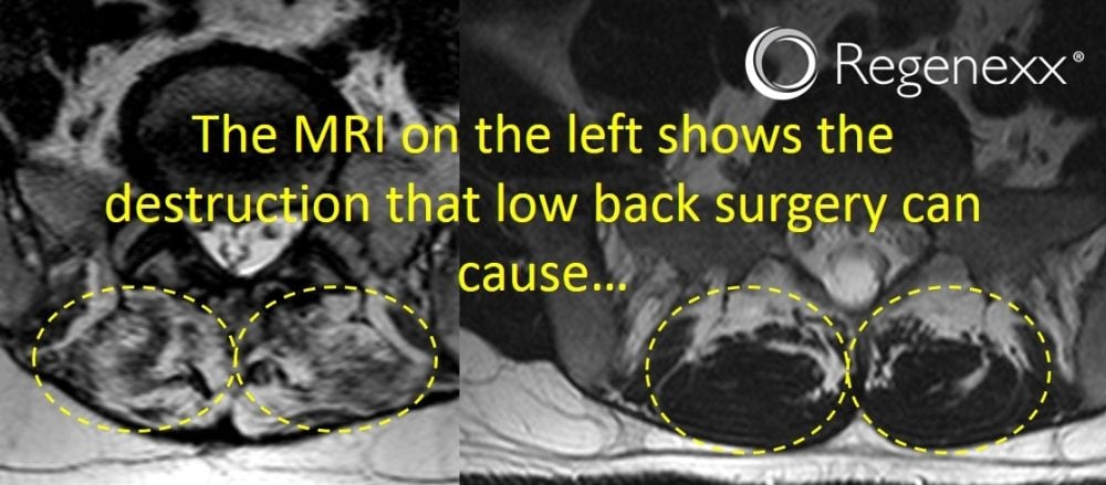 Should I Get Back Surgery? Not After Seeing this MRI…
