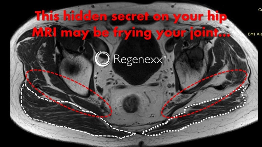 What’s Hiding on Your Hip Arthritis MRI?