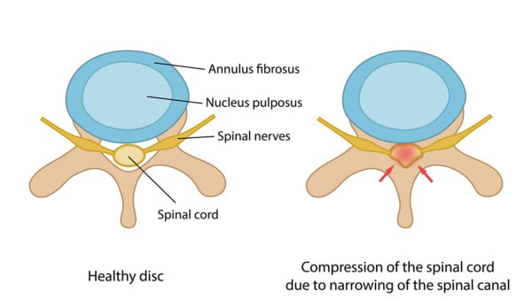 Illustration of a cross section of the spinal cord showing a healthy disc and disc with spinal stenosis