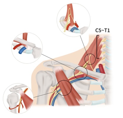 Medical illustration showing thoracic outlet syndrome in the shoulder