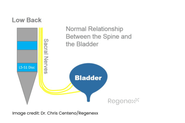 Diagram showing the normal relationship between the spine and the bladder with the sacral nerves coursing by the L5-S1 disc in the low back. 