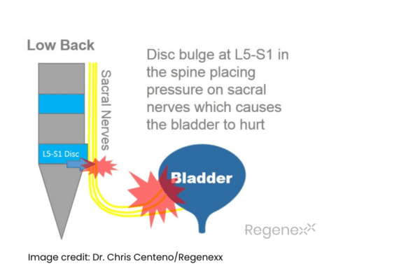 Diagram showing how a L5-S1 disc bulge or “slipped disc” places pressure on the sacral nerves. 