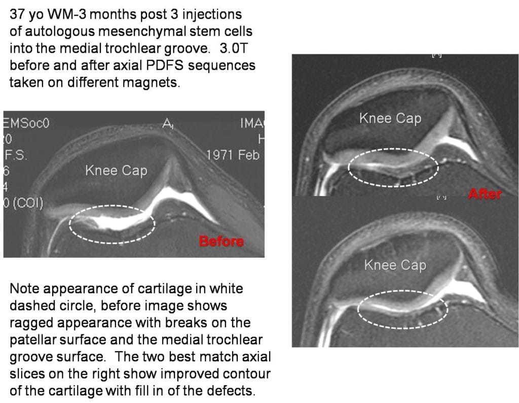 stem cell cartilage regeneration visible on MRI