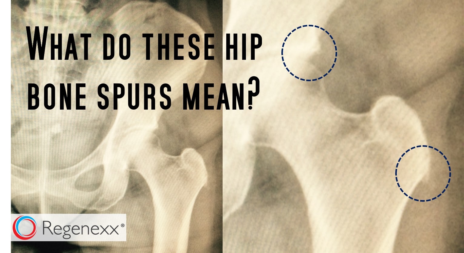 bone-spur-pain-why-relief-may-be-simpler-than-you-think