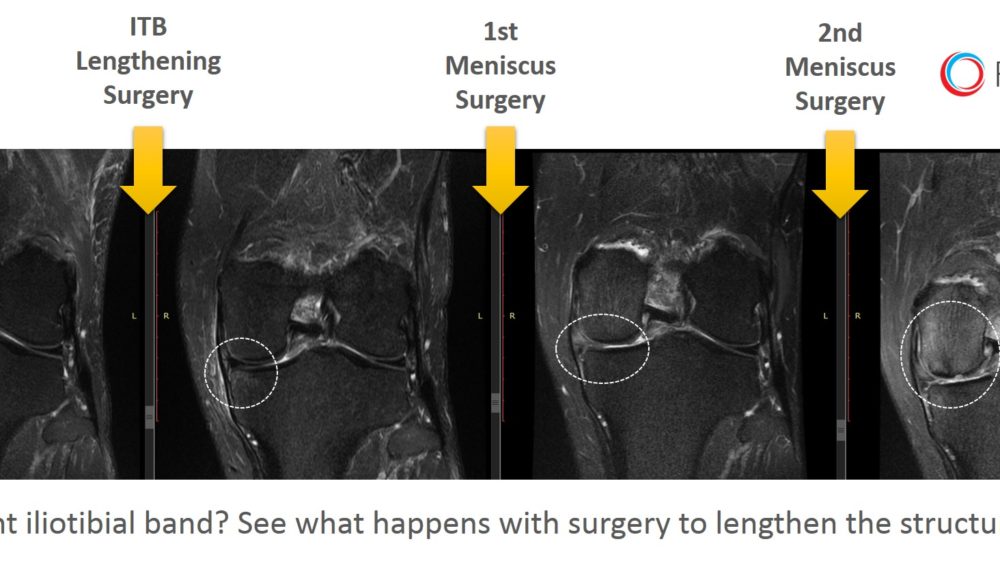 ITB Release Surgery – What Orthopedic Surgeons Won’t Tell You