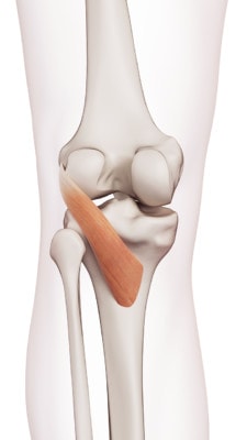 Illustration of the popliteus muscle in the knee.