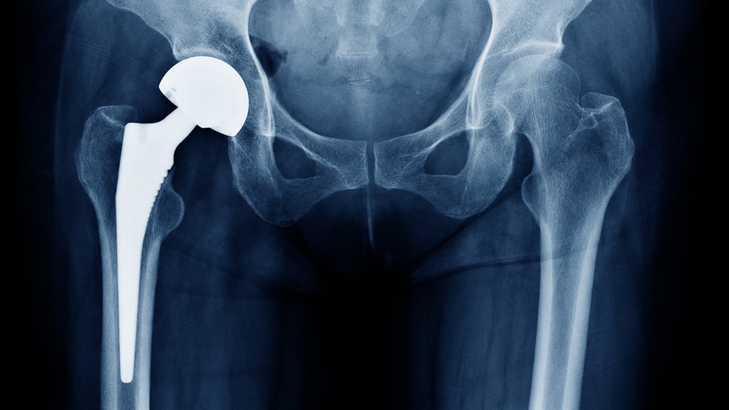 Hip Replacement Materials The Best & Worst Kinds To Use