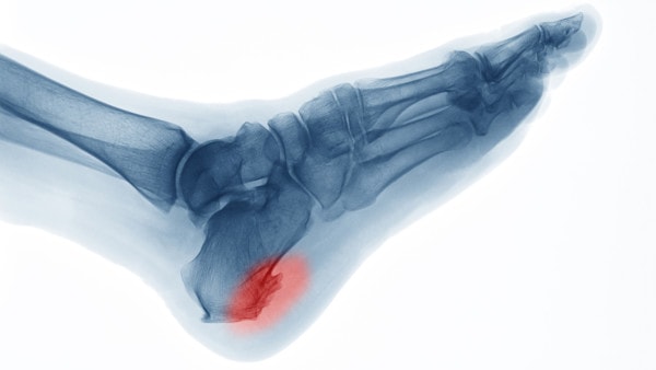 X-ray image of foot, oblique view, showing heel bone spur and inflammation 