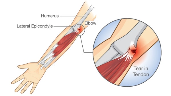 Medical illustration showing a tear in tendon at elbow area known as tennis elbow