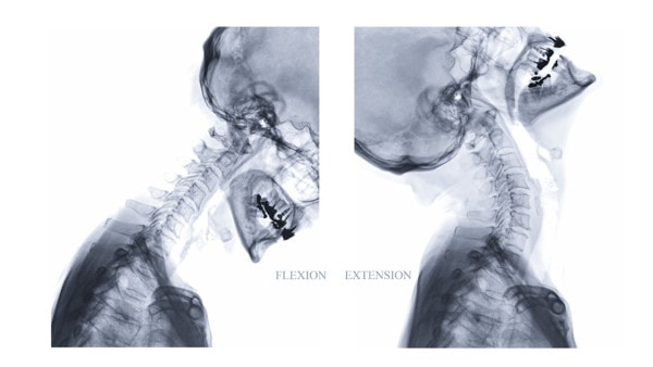 Lateral view X-ray image of the neck or cervical spine showing flexion and extension views