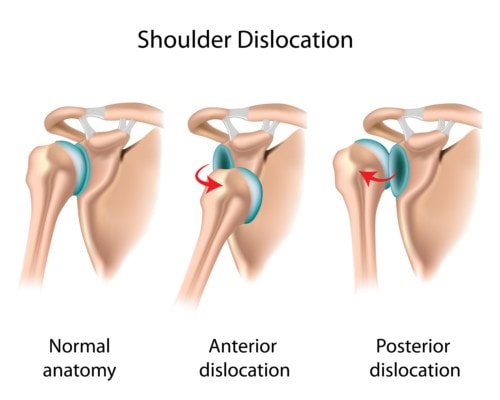 Medical illustration showing healthy shoulder and two types of shoulder dislocation