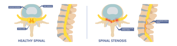Medical illustration comparing a healthy vertebrae and spine to a vertebrae and spine with spinal stenosis