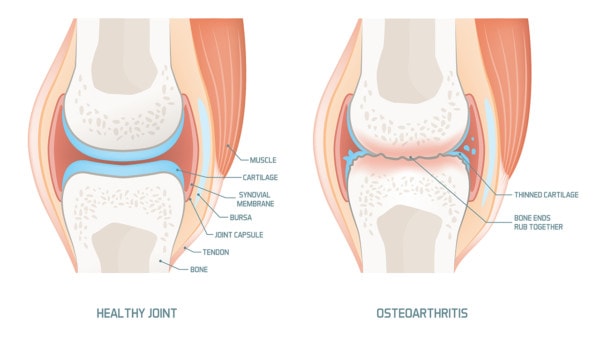 Medical illustration showing the anatomy of a healthy knee and a knee affected by osteoarthritis