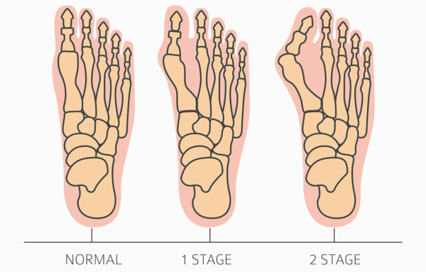 Medical illustration showing overhead view of the bones of a normal foot, the bones in a foot with a moderate bunion and the foot bones of a more severe bunion.
