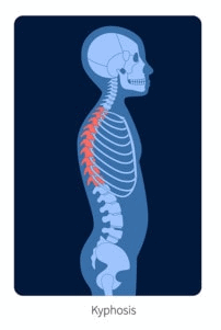 Medical illustration of a kyphosis, which is an exaggerated, forward rounding of the upper back.