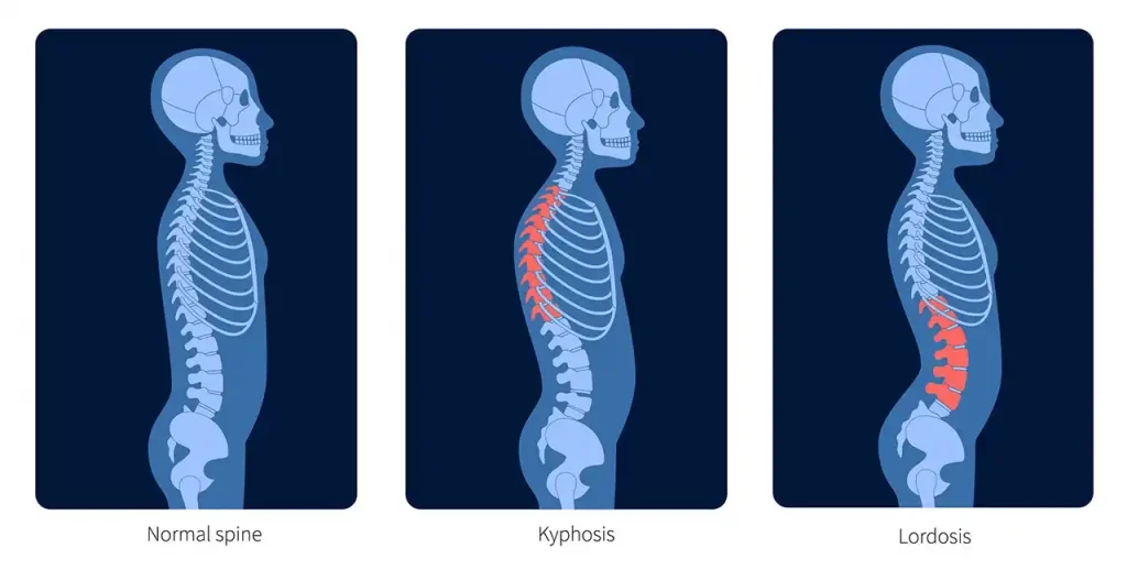 Medical illustration of a normal spine, lordosis and kyphosis.