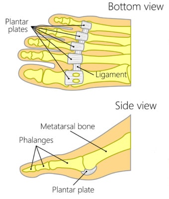 Medical illustration showing two views of the plantar plates in the foot