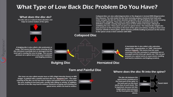 Infographic describing the different types of low back disc problems