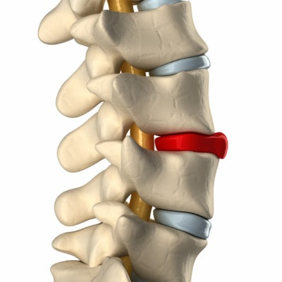 Medical illustration showing a disc degenerated in the spine.