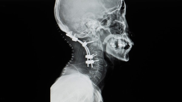 Lateral projection x-ray of cervical spine showing posterior occipitocervical (neck) fixation and fusion