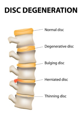Medical illustration showing the various types of disc degeneration