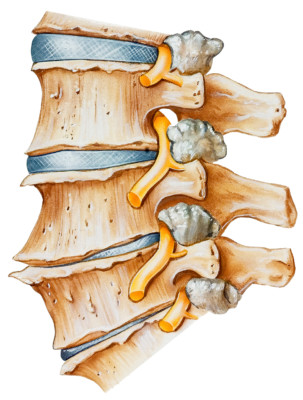 Medical illustration showing a portion of the spine with two healthy discs and two degenerated discs