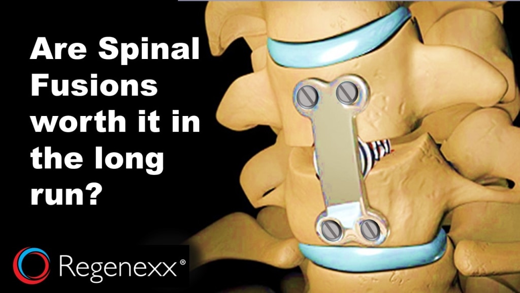 What Are The Types Of Spinal Surgery - Design Talk