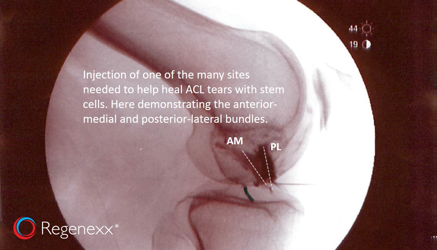 ACL stem cell treatment